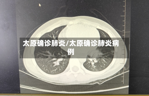 太原确诊肺炎/太原确诊肺炎病例-第3张图片