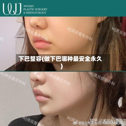 下巴整容(做下巴哪种最安全永久)
