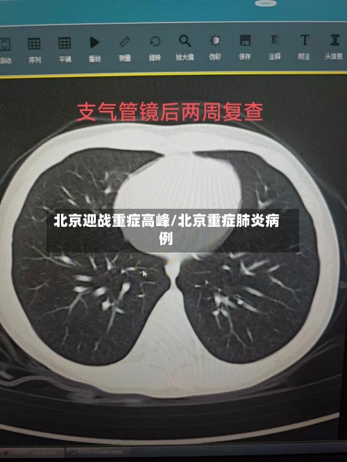 北京迎战重症高峰/北京重症肺炎病例-第3张图片